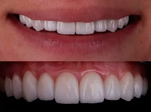Результат зубного протезирования