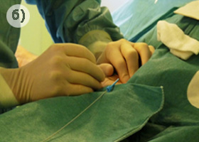 Лечение миомы матки методом эмболизации маточных артерий