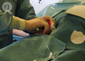 Лечение миомы матки методом эмболизации маточных артерий. Установка интродьюсера.