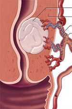 Схематическое изображение катетера в маточной артерии