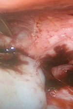 Эндометриоидные гетеротопии на задней поверхности матки + эндометриоидная киста левого яичника