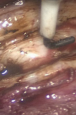 Отсечение тела матки от шейки на уровне внутреннего зева цервикального канала с использованием монополярного электрода