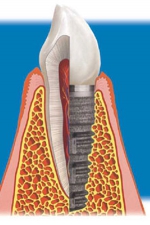 Надежная фиксация имплантата в кости челюсти
