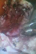 Киста удалена, функционально активная ткань яичника сохранена