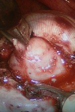 Вылущивание кисты в пределах здоровых тканей яичника
