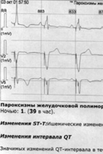 Рис.6 Пароксизм желудочковой полиморфной тахикардии, выявленный при суточном мониторировании