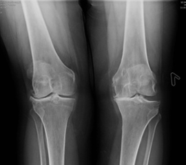 Рис. 1. Рентгенография коленного сустава до операции