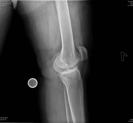 Рис. 2. Рентгенография коленного сустава до операции