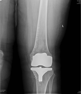 Рис. 3. Рентгенография коленного сустава после операции