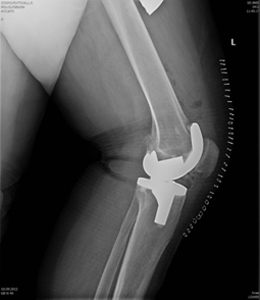 Рис. 4. Рентгенография коленного сустава после операции