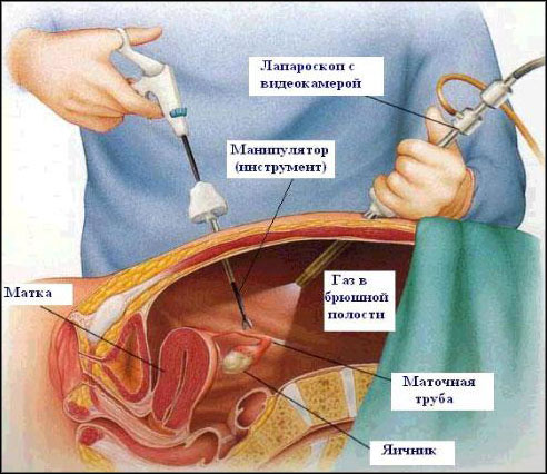 Лапароскопия брюшной полости стерилизация маточных труб