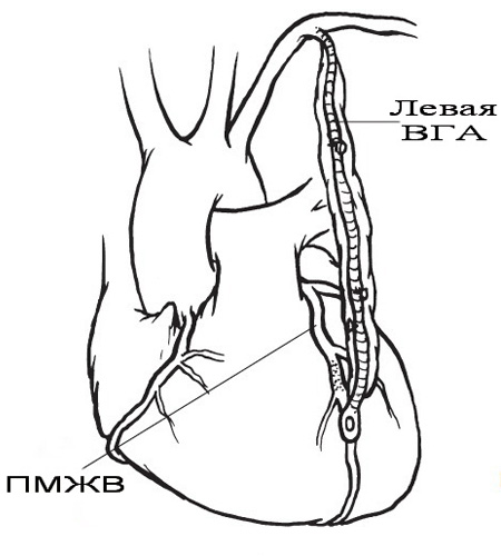 Схема использования левой внутренней грудной артерии