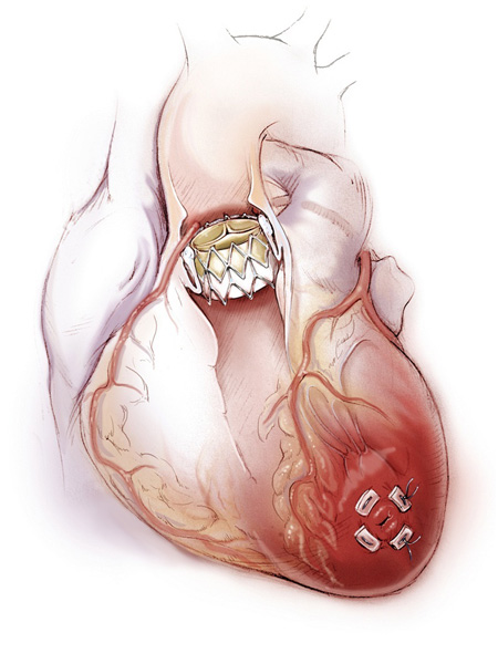 Вид клапана, установленного в аортальную позицию при трансапикальной катетерной имплантации