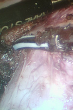 Операция рака шейки матки. Отсечение препарата (матки с шейкой, связочным аппаратом, придатками и влагалищной манжеткой) на уровне между верхней и средней третью влагалища