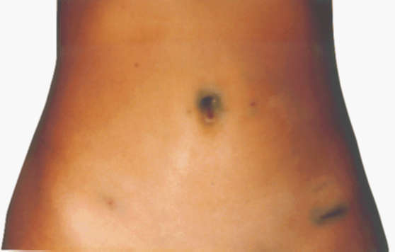 Внешний вид ран после лапароскопической гинекологической операции (4-й день после операции)