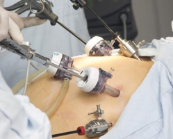 Лапароскопические операции резекции рака ободочной кишки