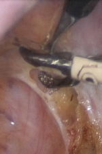 Рассечение брюшины малого таза, которой будет перитонизирован сетчатый имплант в конце операции