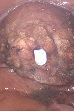 Тело матки отсечено от шейки, удалено из брюшной полости путем морцелляции в эндобэге, в просвете цервикального канала - маточный манипулятор