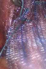 Фиксация сетчатого импланта к передней поверхности шейки матки, влагалища и связочному аппарату