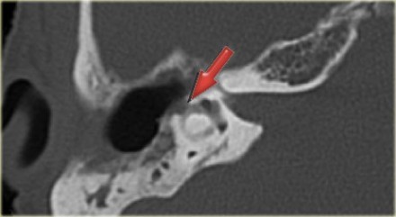 КТ-картина дефекта латерального полукружного канала (фистула) вследствие холестеатомы у 53-летней пациентки с клиникой головокружения