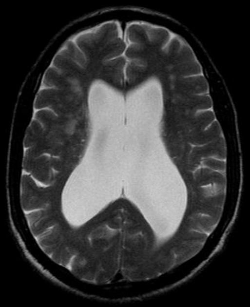 МРТ головы пациента с НТГ: обращает на себя внимание выраженная вентрикуломегалия при отсутствии значимой атрофии вещества головного мозга