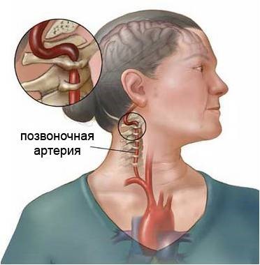 Механическая компрессия позвоночной артерии на уровне шейного отдела позвоночника, лежащая в основе развития инсульта “лучника”.