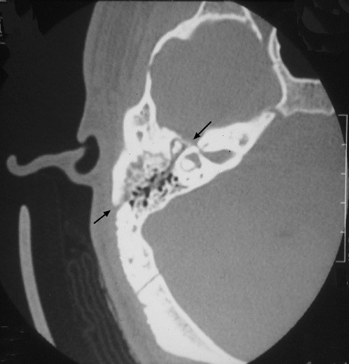 Продольный перелом височной кости у пациента с посттравматическим вестибулопатическим синдромом (компьютерная томография).