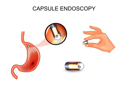 Капсульная эндоскопия