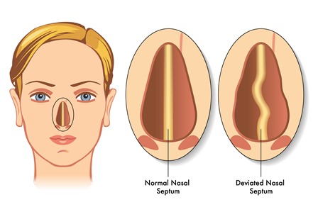 Операции на перегородке носа и септопластика