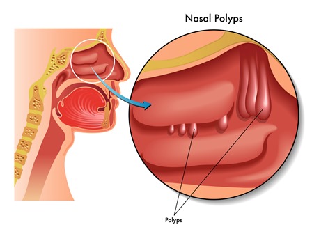 Авторская методика консервативного лечения полипоза носа