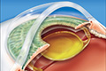 Лечение катаракты в СПБ ГБУЗ «Городская больница» №40