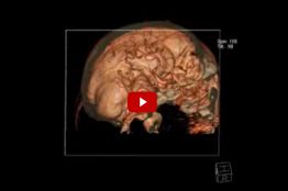 КТ-ангиография сосудов головного мозга
