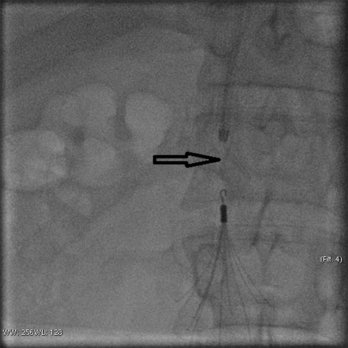 Имплантация и успешное удаление временного фильтра нижней полой вены у пациента молодого возраста